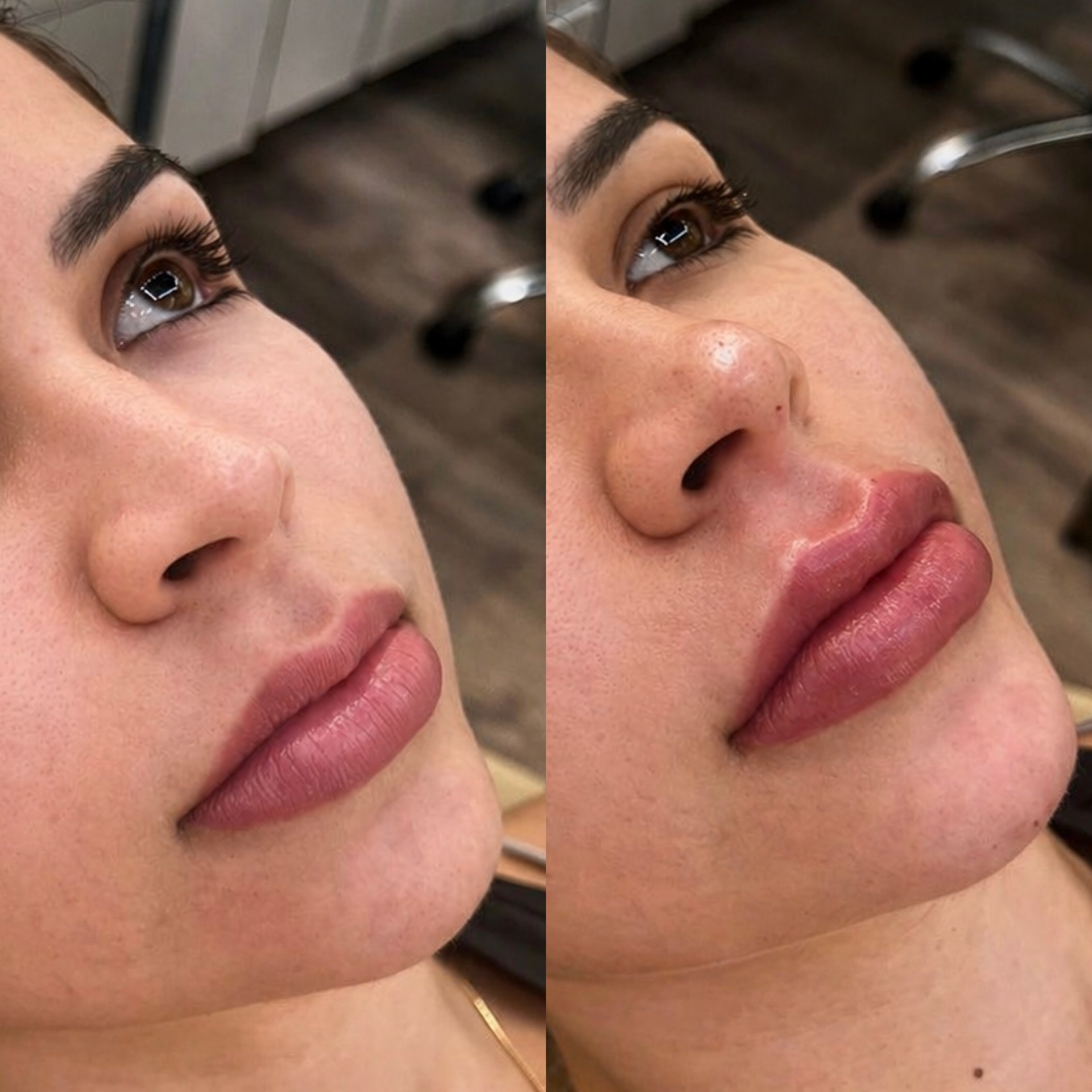 Antes e depois — Preenchimento Labial